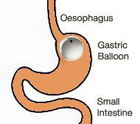 price of gastric bypass surgery ireland